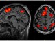 fMRI brain scan