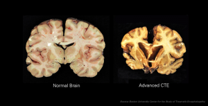 Chronic_Traumatic_Encephalopathy